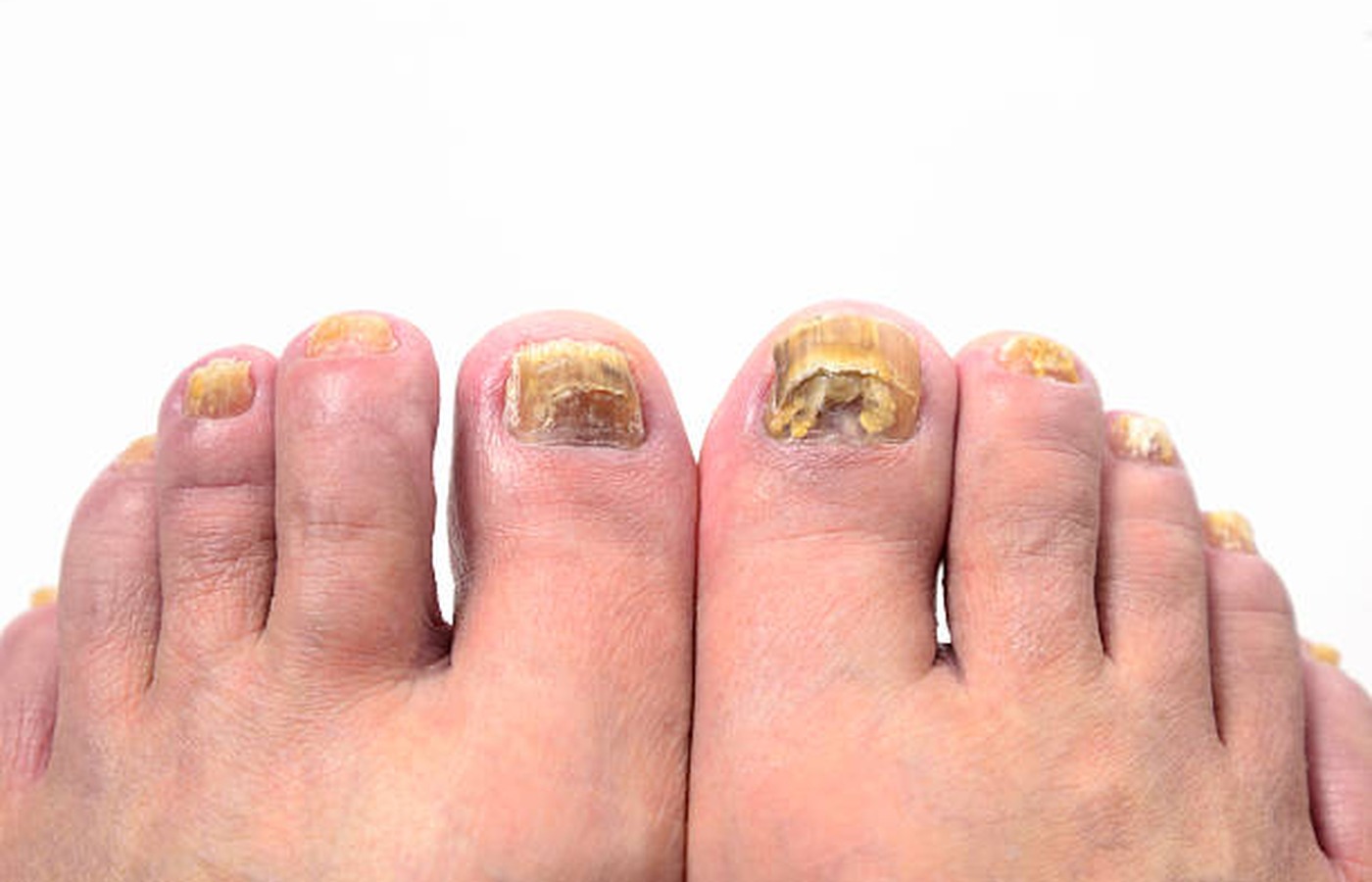 Fungal Nails health guide